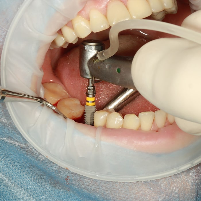 wisdom teeth removal aspendale