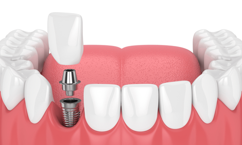 Dental Implants Recommended by Dentists